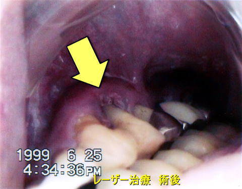 レーザー治療　術後